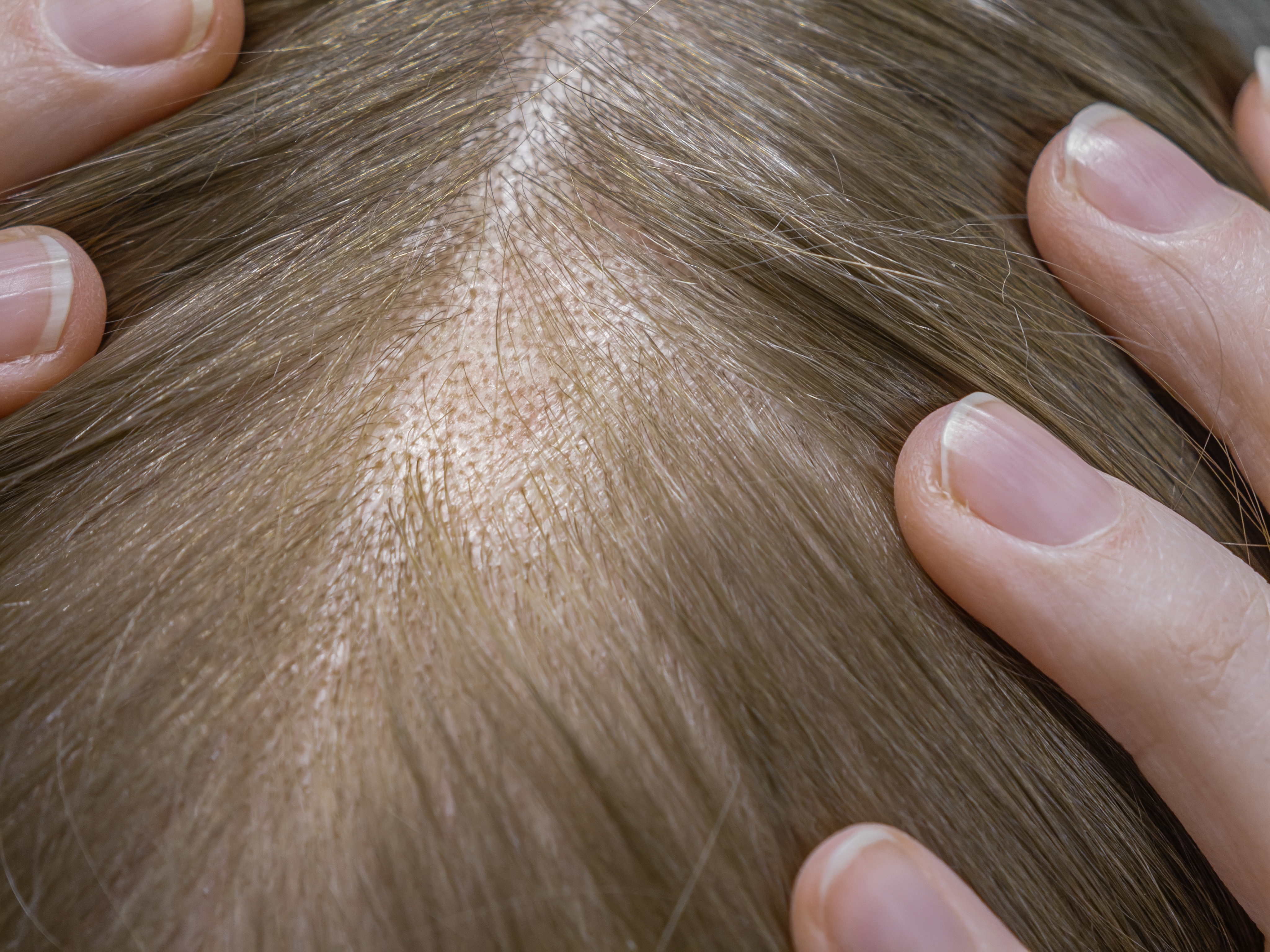 Close up op een vrouwen hoofd; waarin getoond wordt dat de betreffende vrouw haar haren begint te verliezen