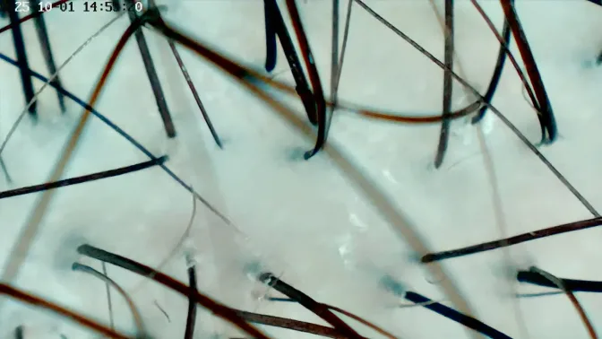 Hoofdhuid na de behandeling