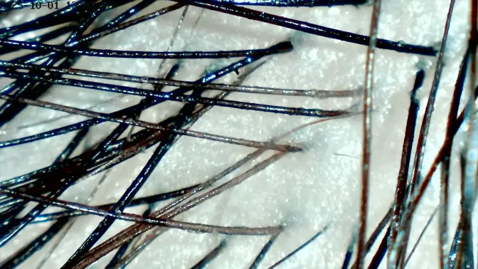 Hoofdhuid voor de behandeling